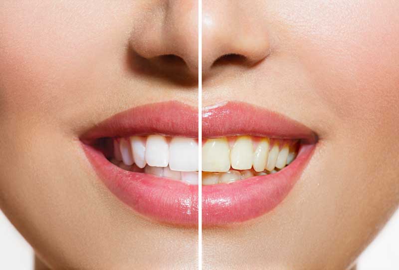 عکس با کیفیت از دندان جرم گیری شده